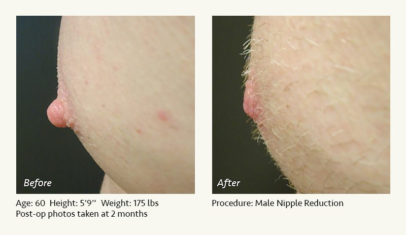 Male Nipple Reduction in Plano, TX - Patient 26