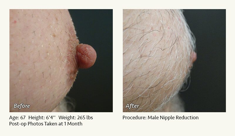 Male Nipple Reduction in Plano, TX - Patient 24