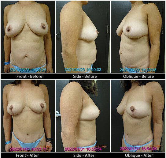 Mommy Makeover in Plano, TX - Patient 8