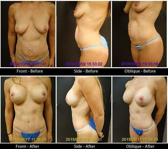Mommy Makeover in Plano, TX - Patient 23