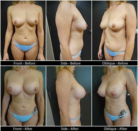 Mommy Makeover in Plano, TX - Patient 14