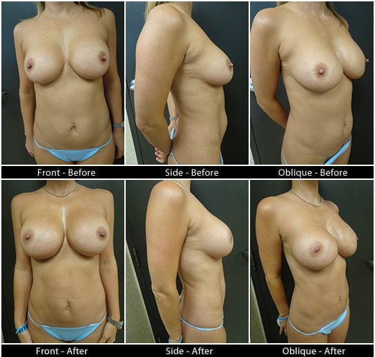 Mommy Makeover in Plano, TX - Patient 16