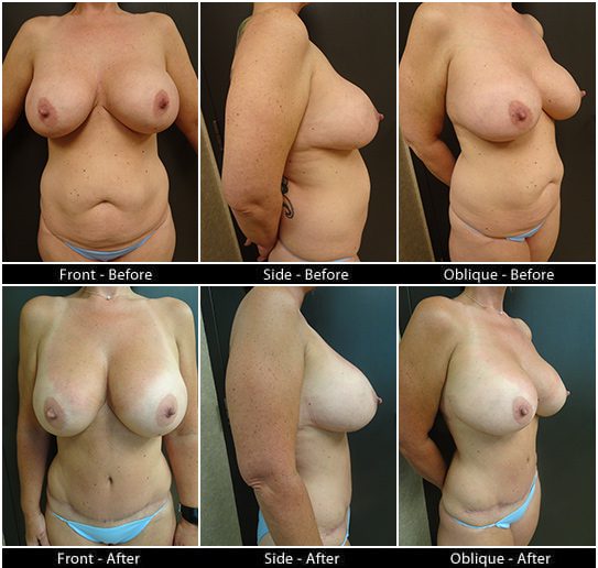 Mommy Makeover in Plano, TX - Patient 12