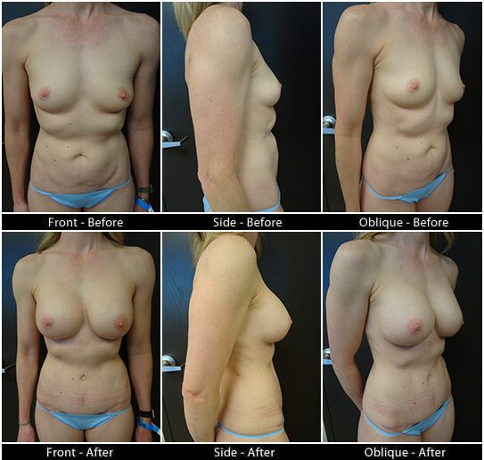 Mommy Makeover in Plano, TX - Patient 11