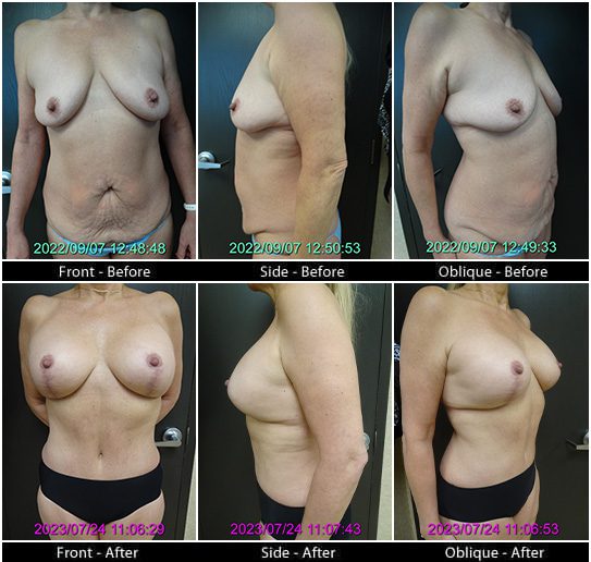 Mommy Makeover in Plano, TX - Patient 2