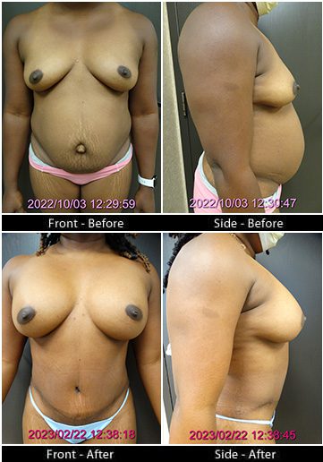 Mommy Makeover in Plano, TX - Patient 1