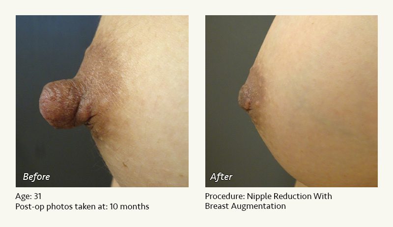 Nipple Procedures (Female) in Plano, TX - Patient 23