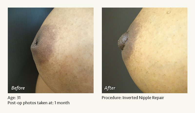 Nipple Procedures (Female) in Plano, TX - Patient 19