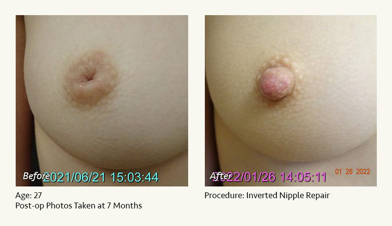 Nipple Procedures (Female) in Plano, TX - Patient 16