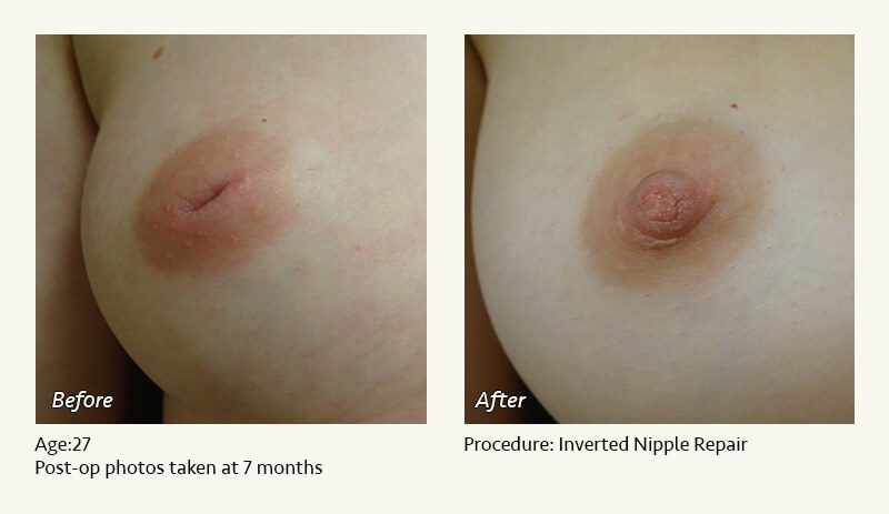 Nipple Procedures (Female) in Plano, TX - Patient 30