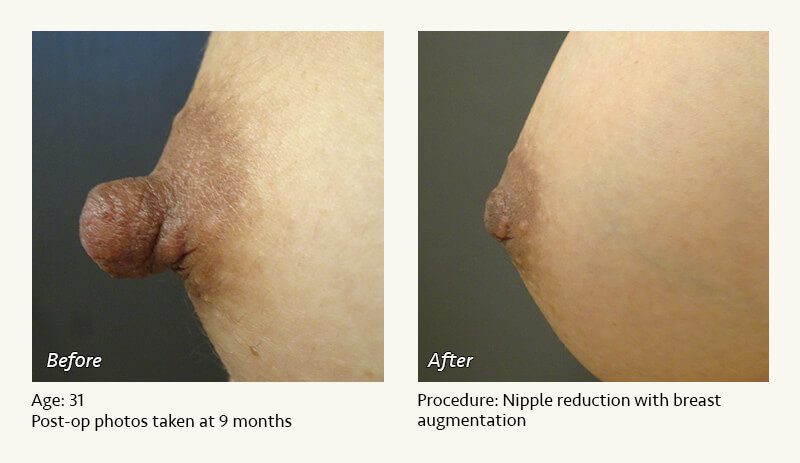 Nipple Procedures (Female) in Plano, TX - Patient 29