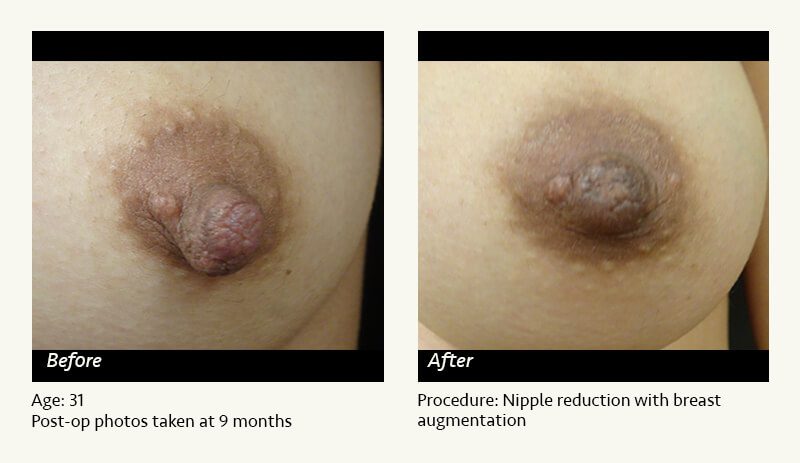 Nipple Procedures (Female) in Plano, TX - Patient 28