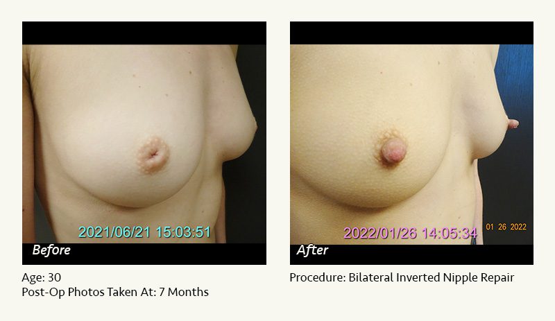 Nipple Procedures (Female) in Plano, TX - Patient 11