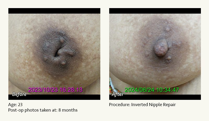 Nipple Procedures (Female) in Plano, TX - Patient 7