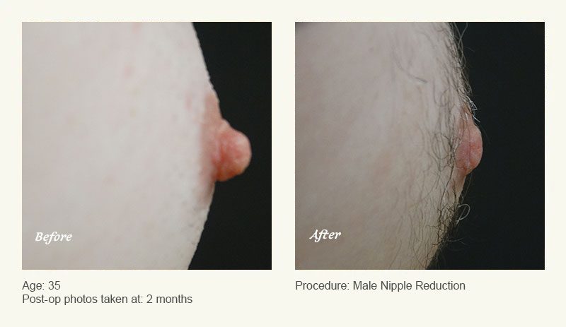 Male Nipple Reduction in Plano, TX - Patient 4