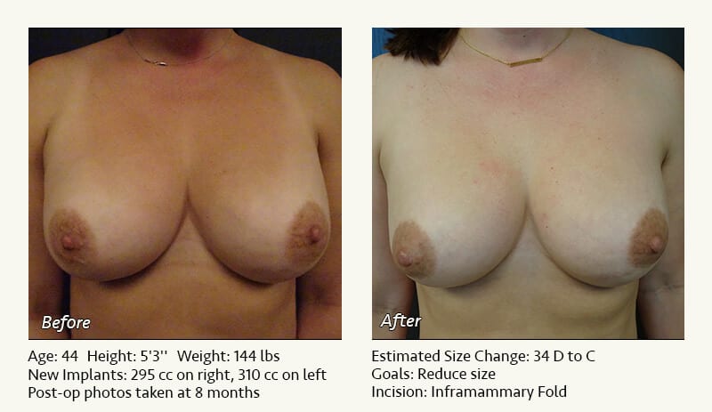 Breast Implant Revision in Plano, TX - Patient 95