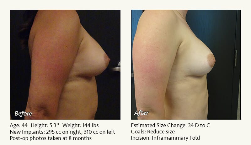 Breast Implant Revision in Plano, TX - Patient 96