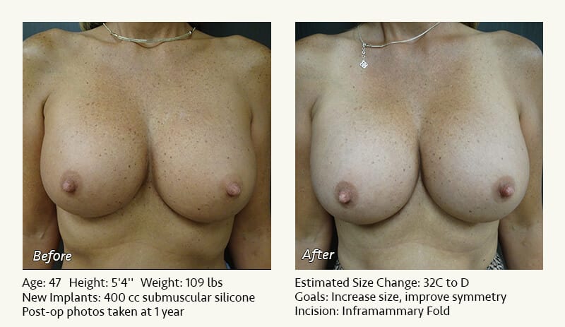 Breast Implant Revision in Plano, TX - Patient 97