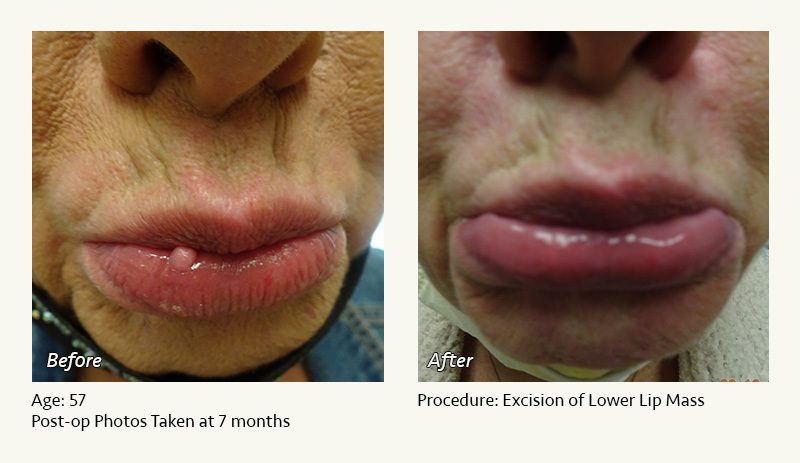 Reconstructive Surgery in Plano, TX - Patient 8
