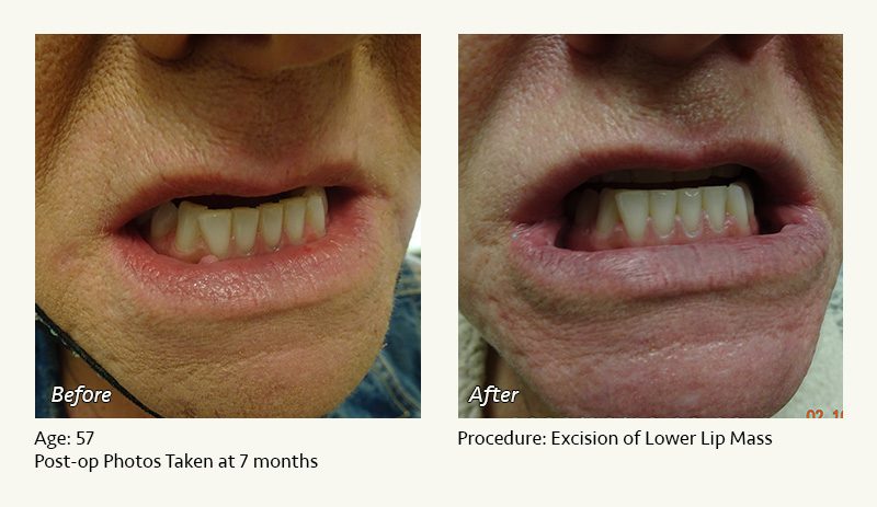 Reconstructive Surgery in Plano, TX - Patient 7