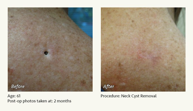 Reconstructive Surgery in Plano, TX - Patient 5