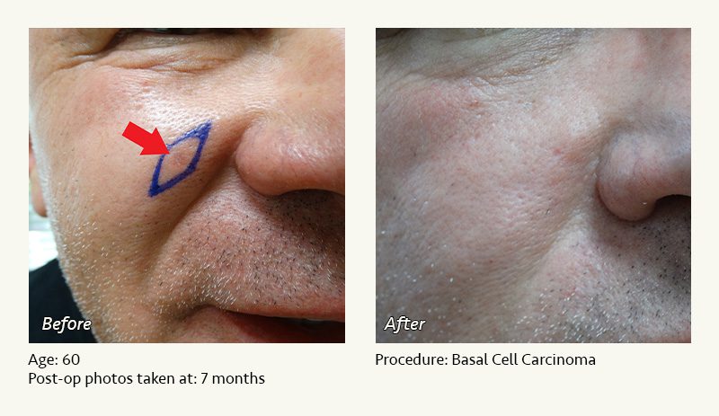 Reconstructive Surgery in Plano, TX - Patient 4