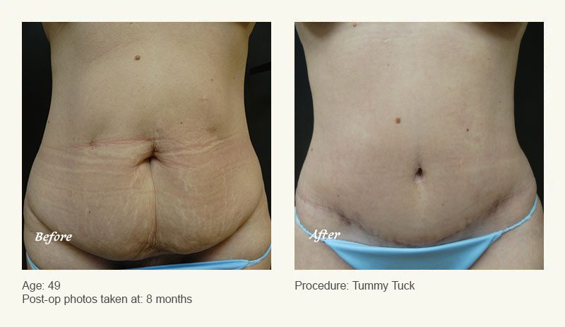 Tummy Tuck in Plano, TX - Patient 7
