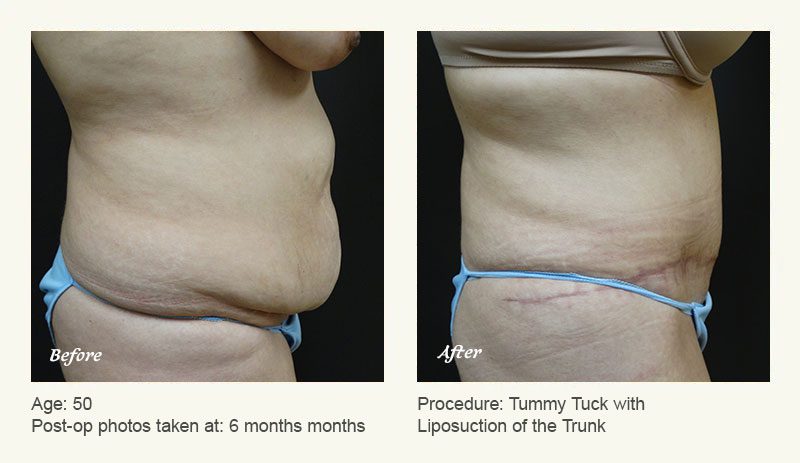 Tummy Tuck in Plano, TX - Patient 16