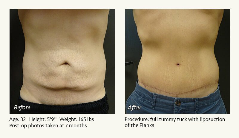Tummy Tuck in Plano, TX - Patient 47
