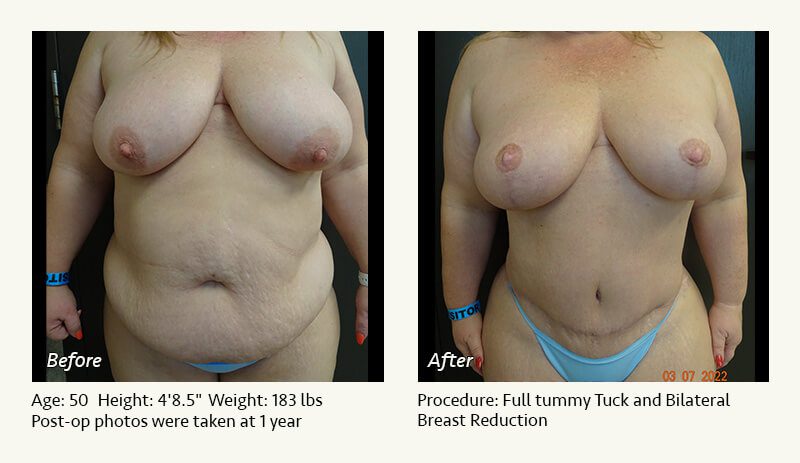 Tummy Tuck in Plano, TX - Patient 37