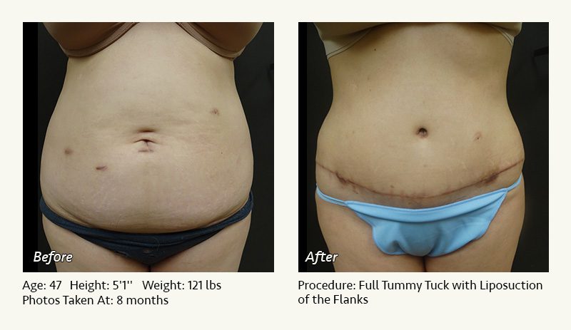 Tummy Tuck in Plano, TX - Patient 33