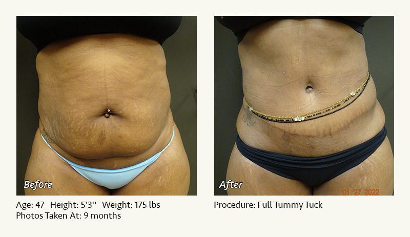 Tummy Tuck in Plano, TX - Patient 31