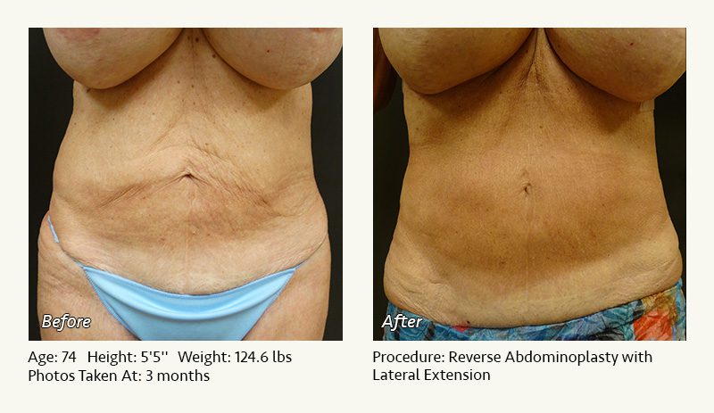 Tummy Tuck in Plano, TX - Patient 27