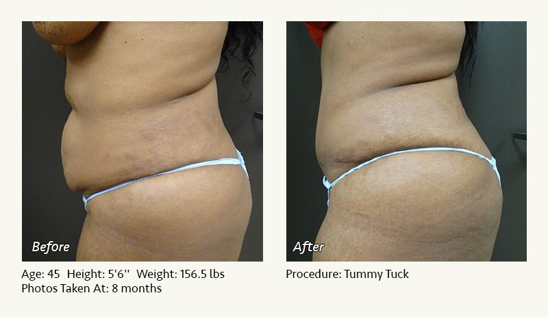 Tummy Tuck in Plano, TX - Patient 26