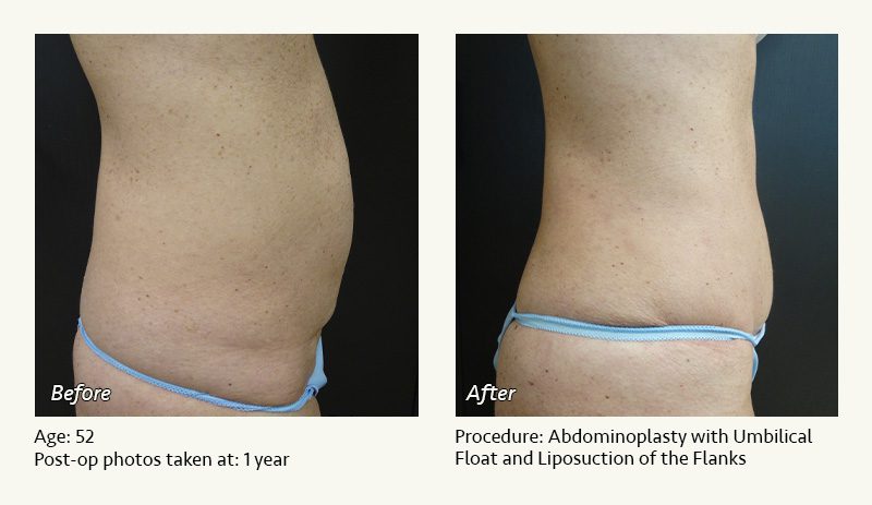 Tummy Tuck in Plano, TX - Patient 24