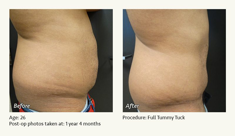 Tummy Tuck in Plano, TX - Patient 20