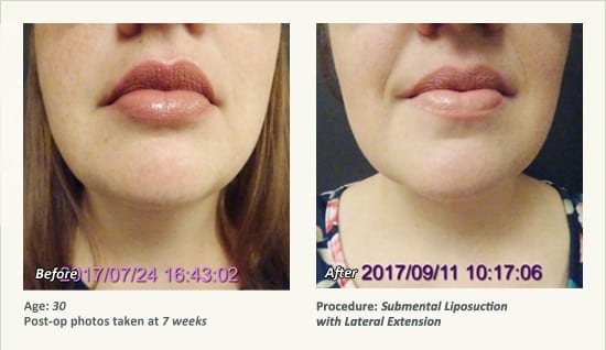 Chin Liposuction in Plano, TX - Patient 87