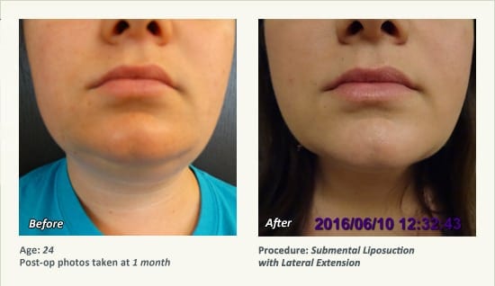 Chin Liposuction in Plano, TX - Patient 75