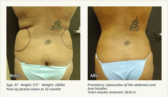 Liposuction Surgery in Dallas & Plano - Patient 24