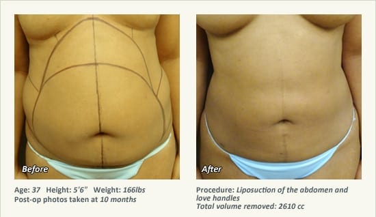 Liposuction Surgery in Dallas & Plano - Patient 23