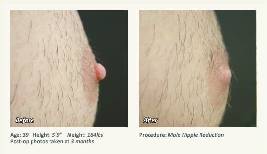 Male Nipple Reduction in Plano, TX - Patient 38