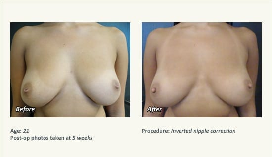 Nipple Procedures (Female) in Plano, TX - Patient 46