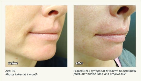 Restylane® & JUVÉDERM® Gel Injectable Fillers In Plano, TX - Patient 43
