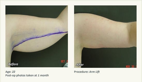 Arm Lift Surgery in Plano, TX - Patient 9