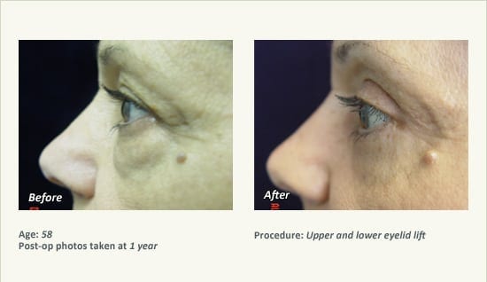Eyelid Lift Surgery in Plano, TX - Patient 20