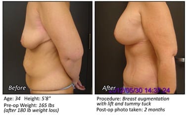 Body Contouring After Weight Loss in Plano, TX - Patient 4