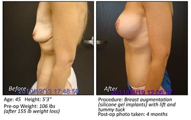 Body Contouring After Weight Loss in Plano, TX - Patient 6