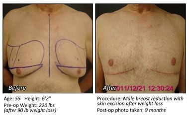 Body Contouring After Weight Loss in Plano, TX - Patient 19