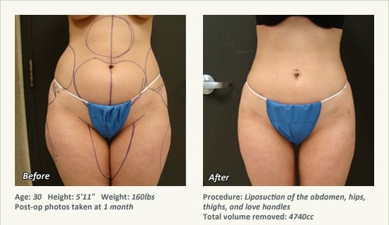 Liposuction Surgery in Dallas & Plano - Patient 25