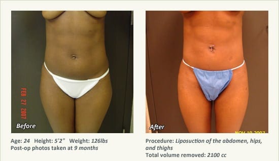 Liposuction Surgery in Dallas & Plano - Patient 27